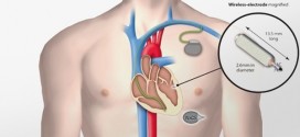 Le plus petit pacemaker au monde