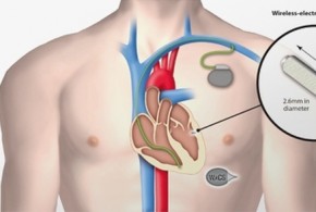 Le plus petit pacemaker au monde